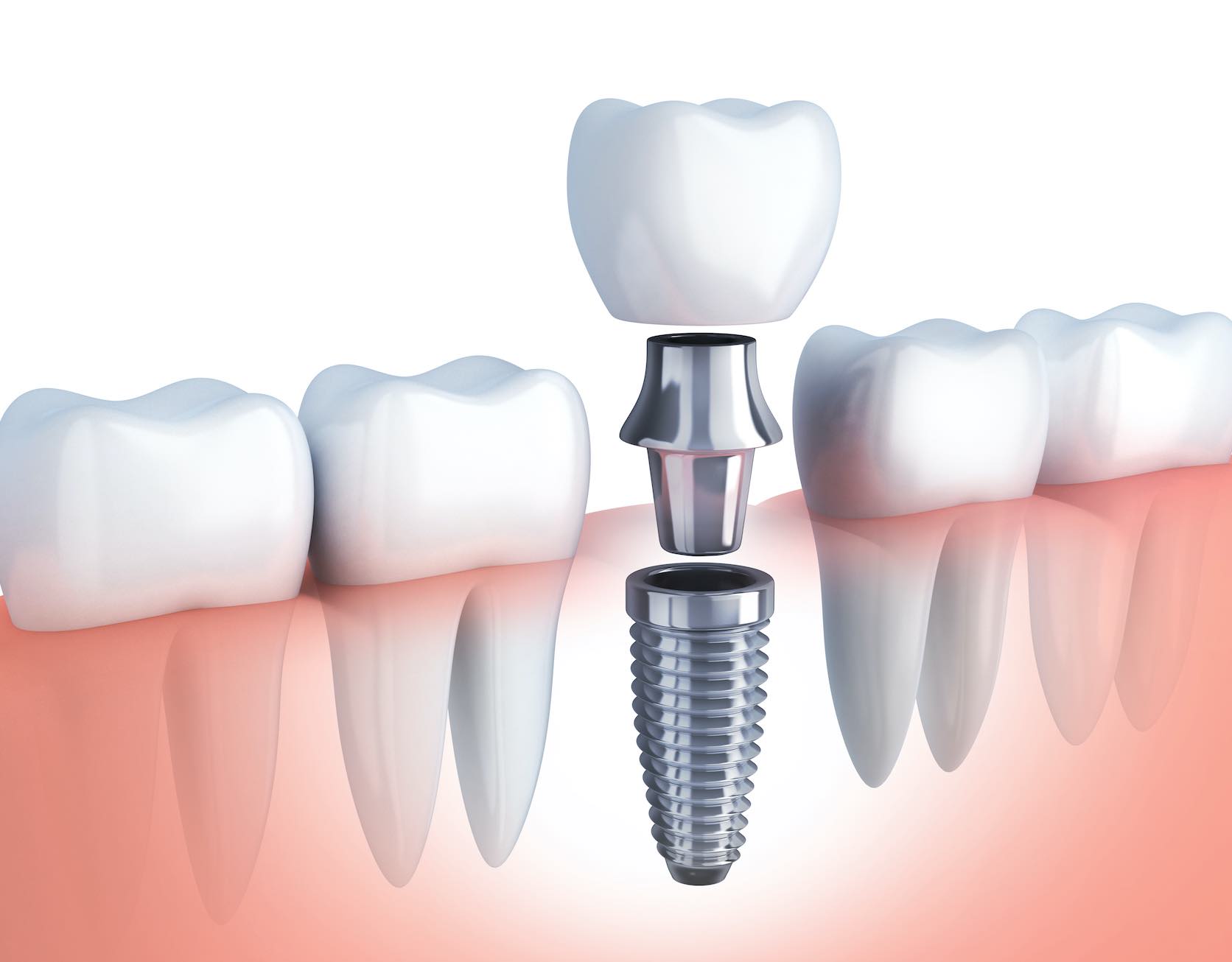 Implantes dentales en Sevilla