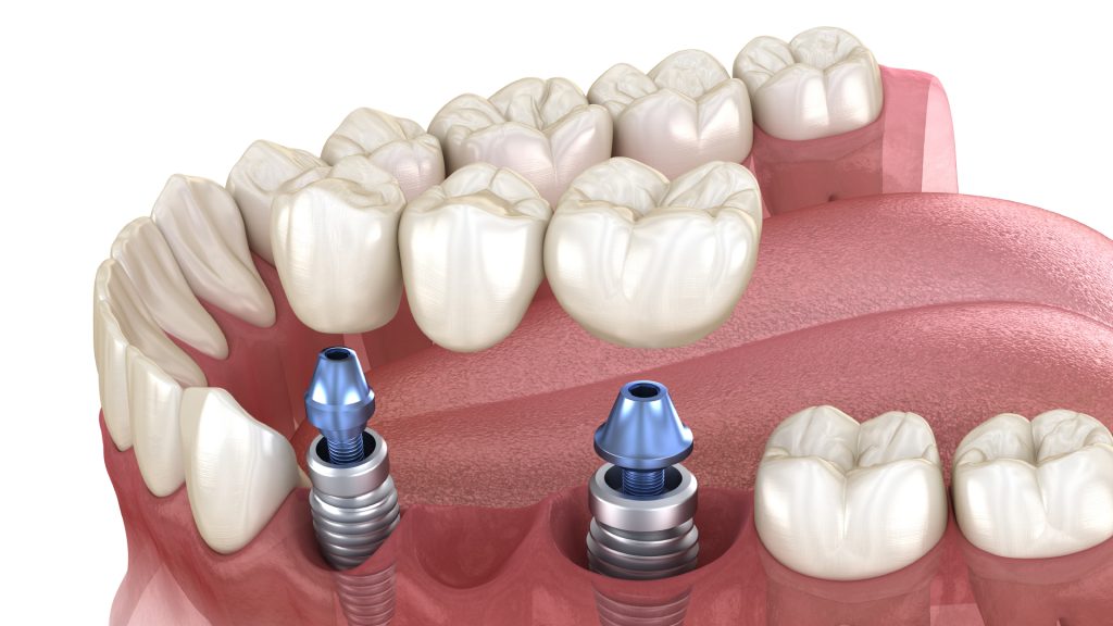 partes del implante dental